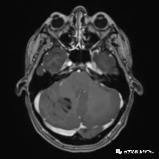 【病例】小脑发育不良性神经节细胞瘤1例MR影像表现