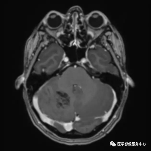 【病例】小脑发育不良性神经节细胞瘤1例MR影像表现