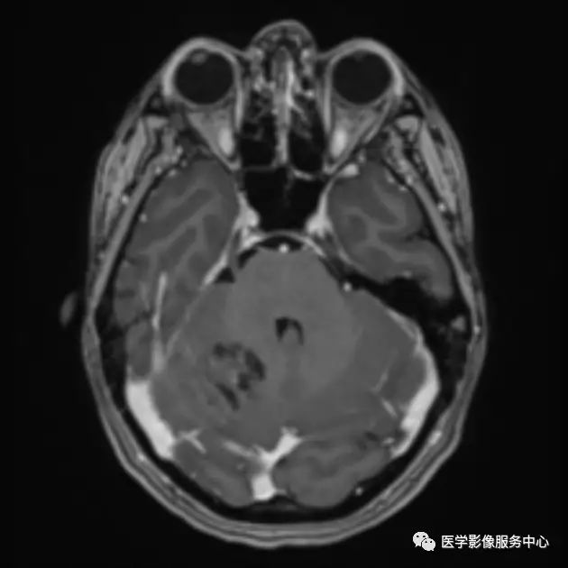 【病例】小脑发育不良性神经节细胞瘤1例MR影像表现