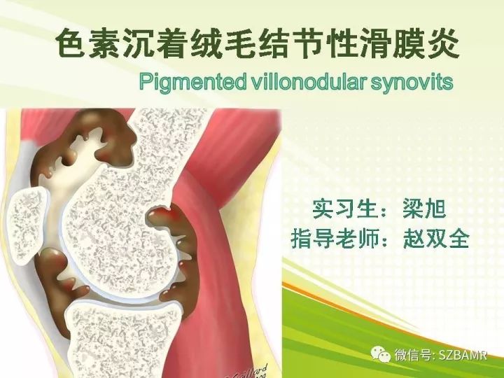 【PPT】色素沉着绒毛结节性滑膜炎