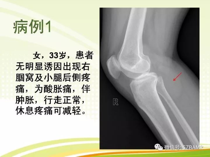 【PPT】色素沉着绒毛结节性滑膜炎