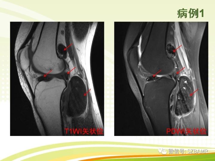 【PPT】色素沉着绒毛结节性滑膜炎