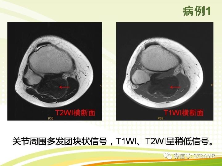 【PPT】色素沉着绒毛结节性滑膜炎