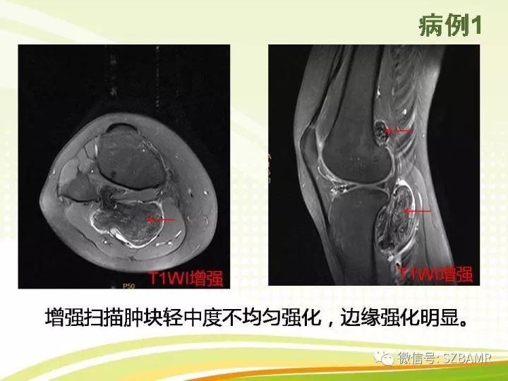 【PPT】色素沉着绒毛结节性滑膜炎