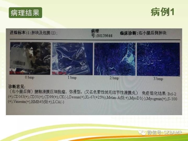 【PPT】色素沉着绒毛结节性滑膜炎