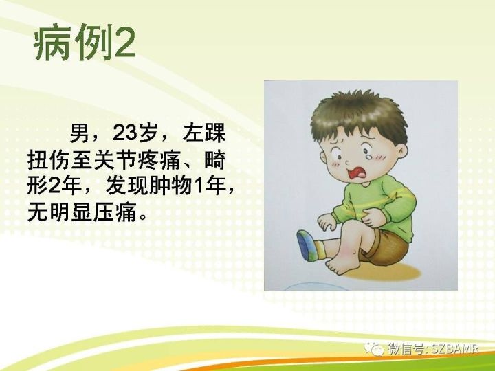 【PPT】色素沉着绒毛结节性滑膜炎