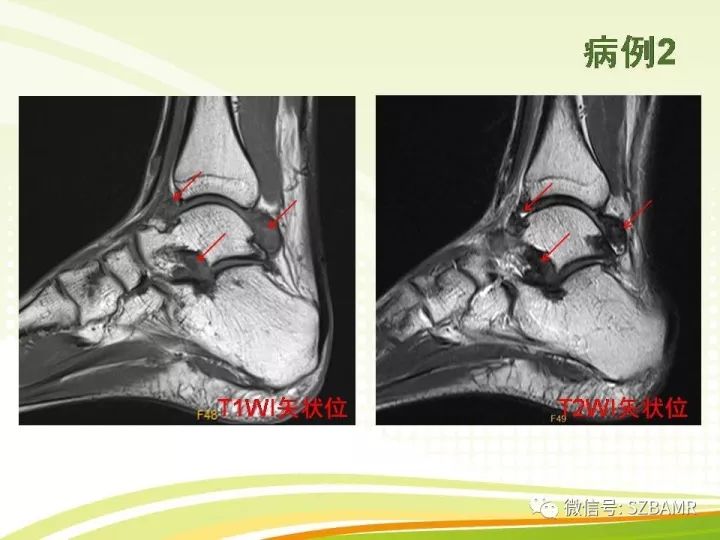【PPT】色素沉着绒毛结节性滑膜炎