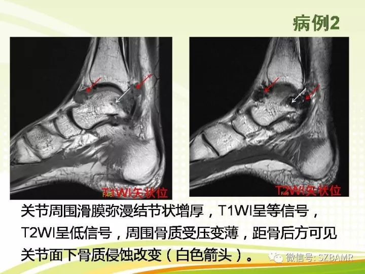 【PPT】色素沉着绒毛结节性滑膜炎