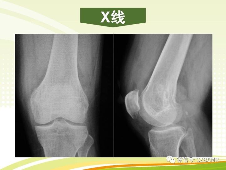 【PPT】色素沉着绒毛结节性滑膜炎