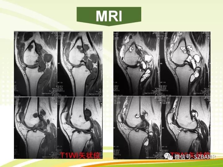 【PPT】色素沉着绒毛结节性滑膜炎