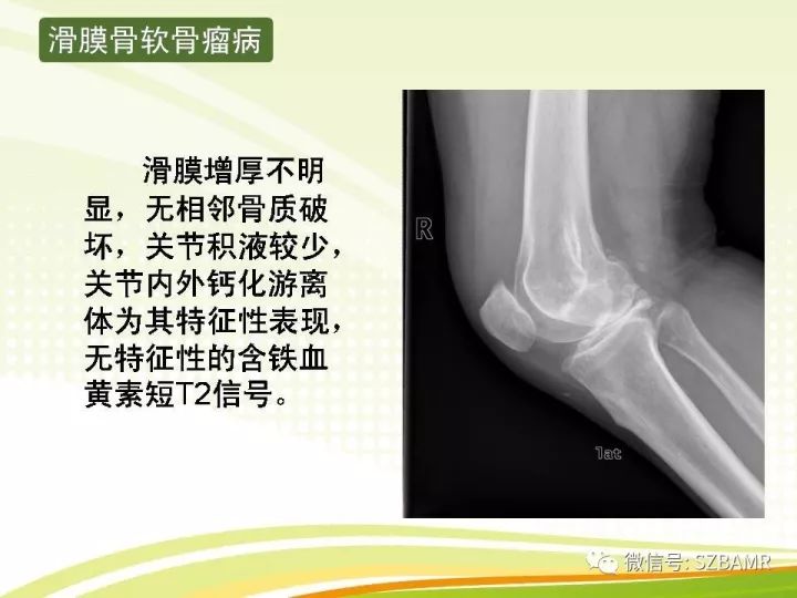 【PPT】色素沉着绒毛结节性滑膜炎