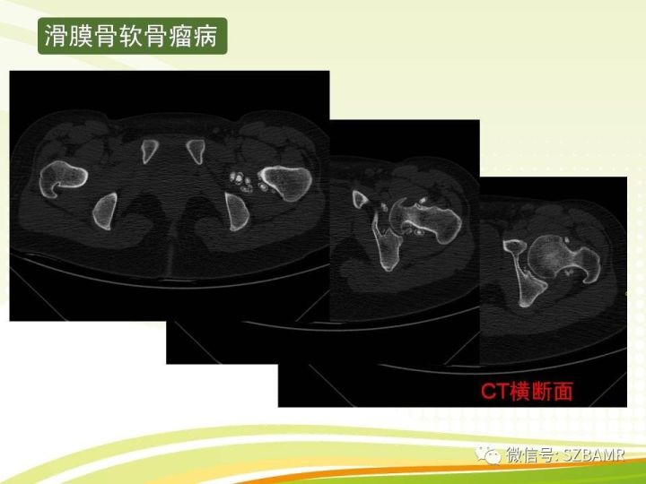 【PPT】色素沉着绒毛结节性滑膜炎