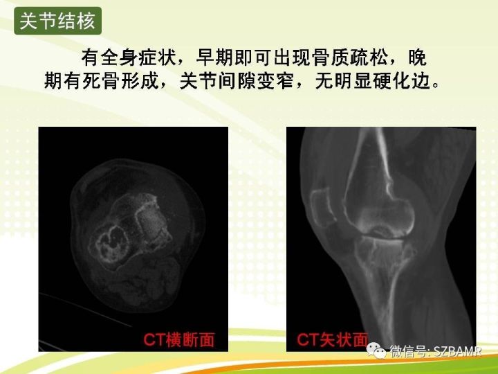 【PPT】色素沉着绒毛结节性滑膜炎
