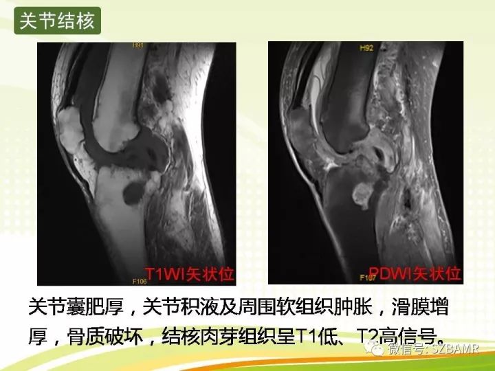【PPT】色素沉着绒毛结节性滑膜炎