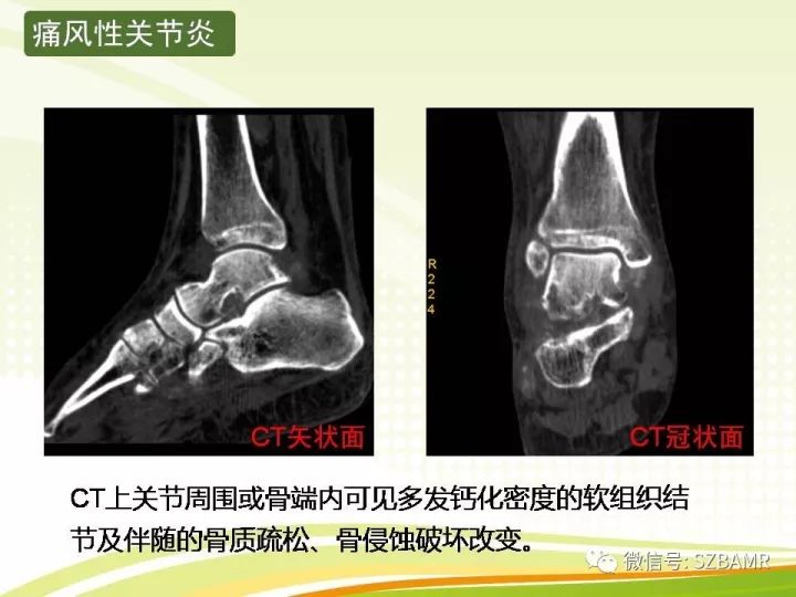 【PPT】色素沉着绒毛结节性滑膜炎