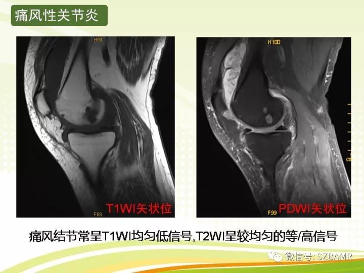 【PPT】色素沉着绒毛结节性滑膜炎
