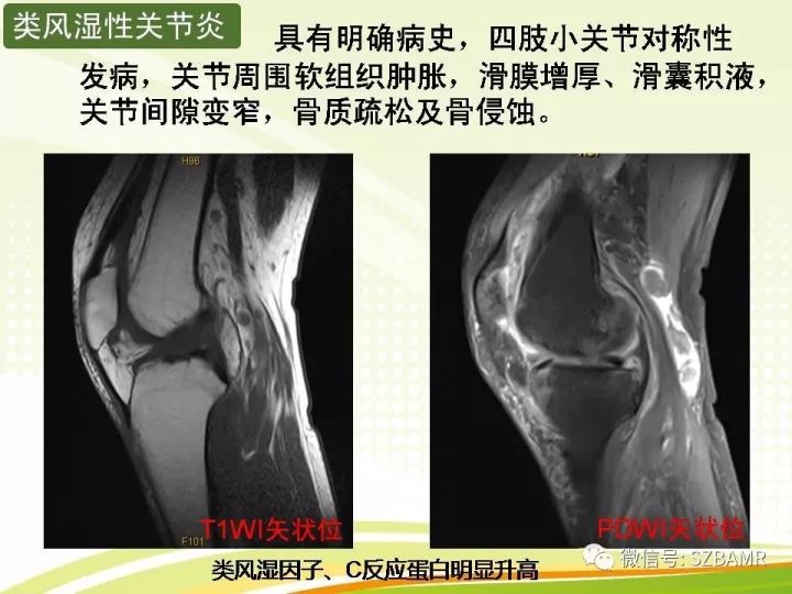 【PPT】色素沉着绒毛结节性滑膜炎