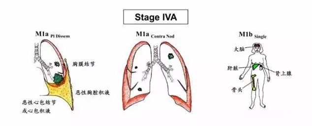 纵膈及肺部淋巴结分区解读 纵膈及肺部淋巴结分区解读