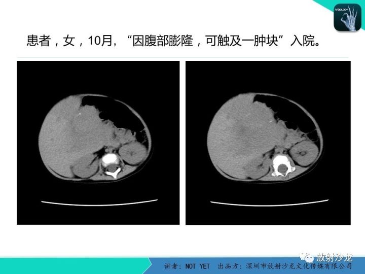 【病例】肝母细胞瘤1例CT影像表现