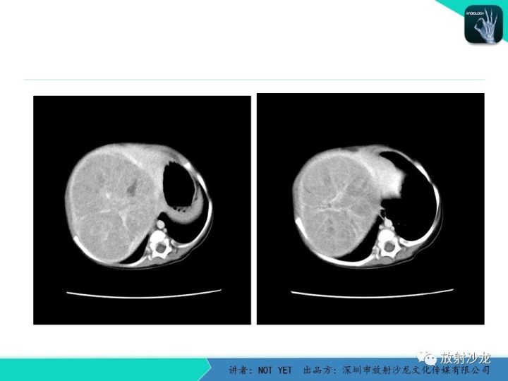 【病例】肝母细胞瘤1例CT影像表现