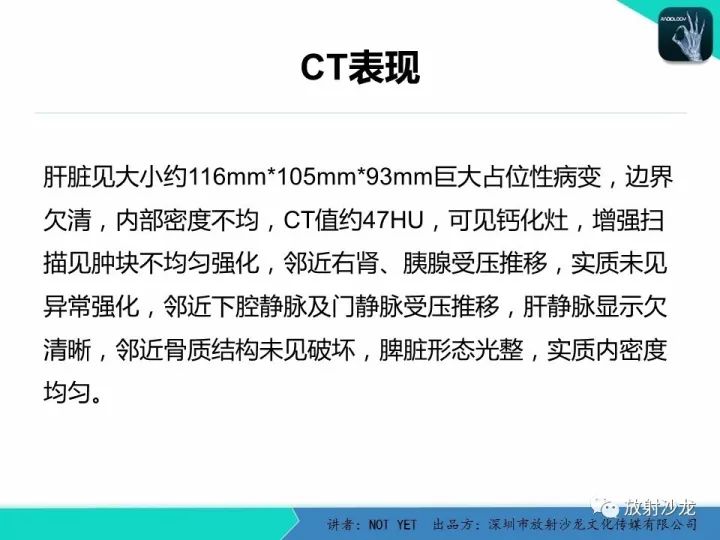 【病例】肝母细胞瘤1例CT影像表现