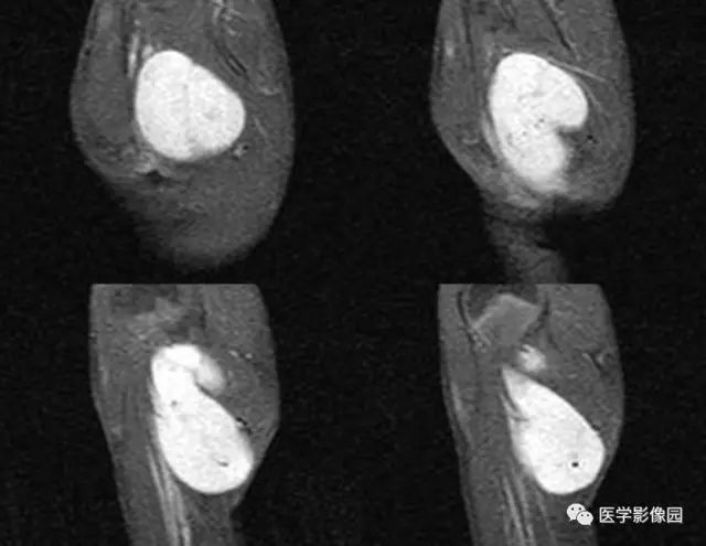 【病例】左腋下粘液样脂肪肉瘤1例MR