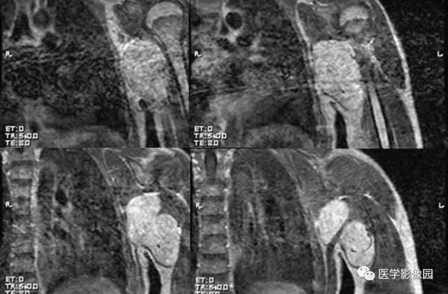 【病例】左腋下粘液样脂肪肉瘤1例MR