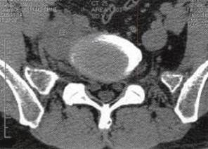【病例】腹膜后节细胞神经瘤1例CT影像表现 【病例】腹膜后节细胞神经瘤1例CT影像表现