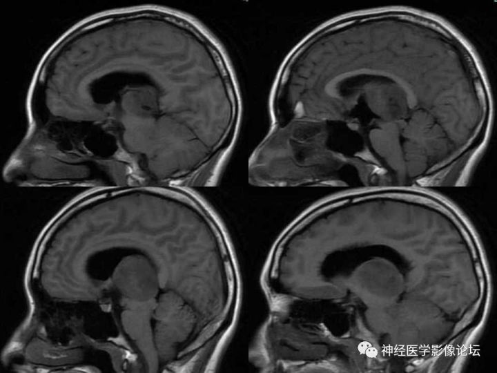 【病例】右侧丘脑间变型星形细胞瘤1例MR影像表现