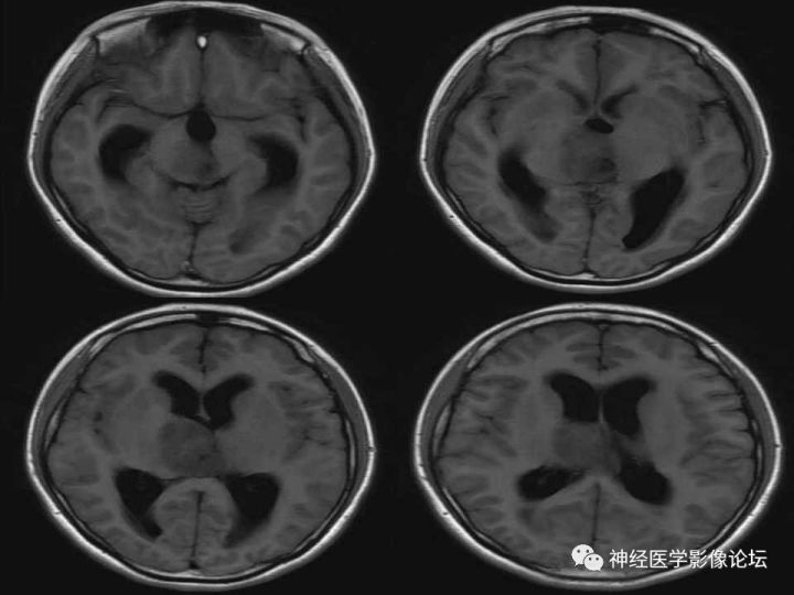 【病例】右侧丘脑间变型星形细胞瘤1例MR影像表现