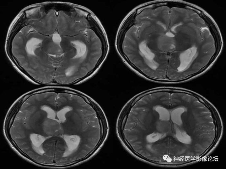【病例】右侧丘脑间变型星形细胞瘤1例MR影像表现