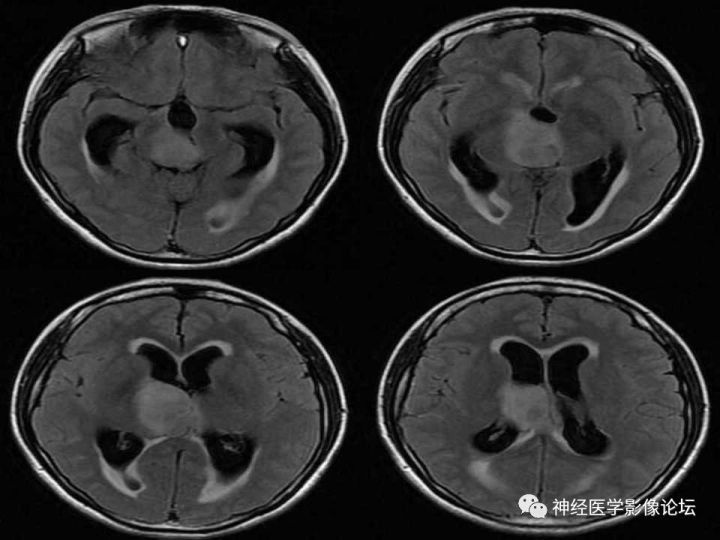 【病例】右侧丘脑间变型星形细胞瘤1例MR影像表现