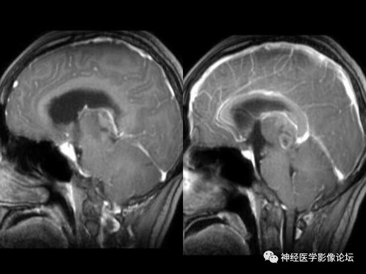 【病例】右侧丘脑间变型星形细胞瘤1例MR影像表现
