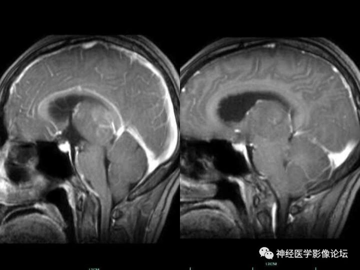 【病例】右侧丘脑间变型星形细胞瘤1例MR影像表现