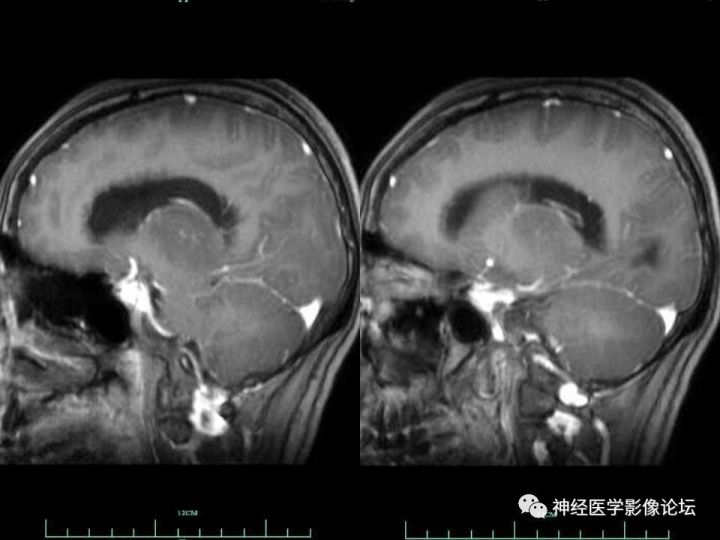 【病例】右侧丘脑间变型星形细胞瘤1例MR影像表现