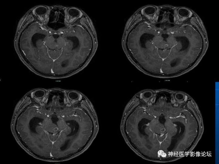 【病例】右侧丘脑间变型星形细胞瘤1例MR影像表现
