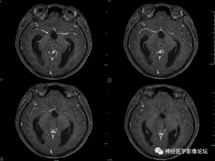 【病例】右侧丘脑间变型星形细胞瘤1例MR影像表现