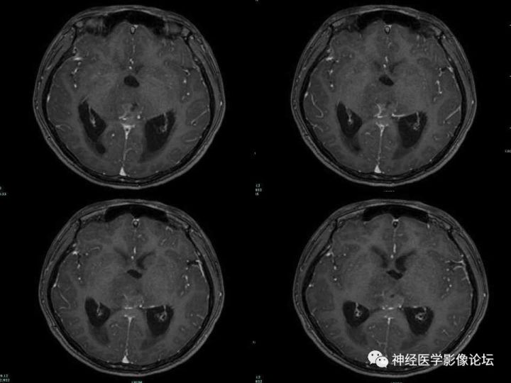【病例】右侧丘脑间变型星形细胞瘤1例MR影像表现