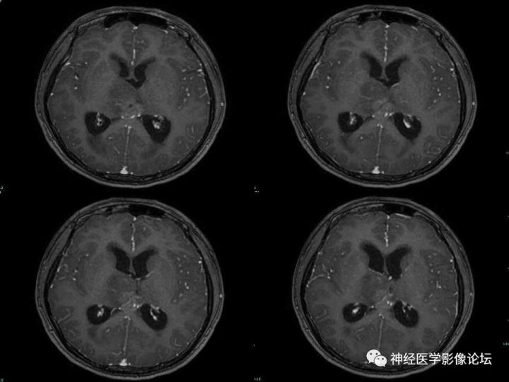 【病例】右侧丘脑间变型星形细胞瘤1例MR影像表现