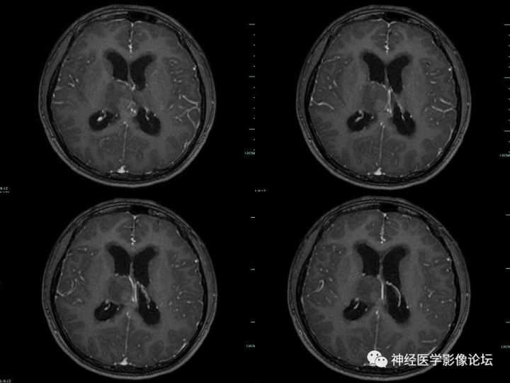 【病例】右侧丘脑间变型星形细胞瘤1例MR影像表现