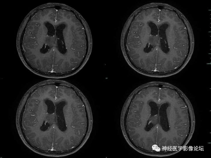 【病例】右侧丘脑间变型星形细胞瘤1例MR影像表现