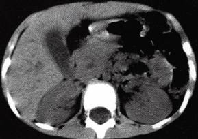 【病例】胆管蛔虫症1例CT影像特点 【病例】胆管蛔虫症1例CT影像特点