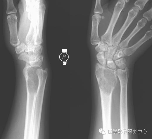 经典、罕见的X线片病例 经典、罕见的X线片病例