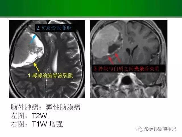 【PPT】颅内占位的分析步骤
