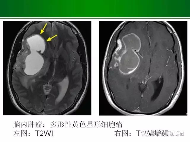 【PPT】颅内占位的分析步骤