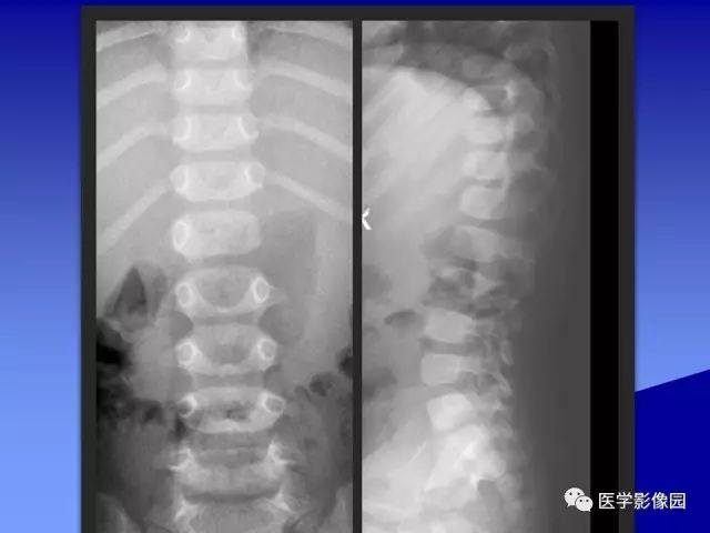 【病例】腰椎嗜酸性肉芽肿1例X线CT及MR影像表现