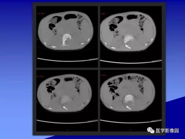 【病例】腰椎嗜酸性肉芽肿1例X线CT及MR影像表现