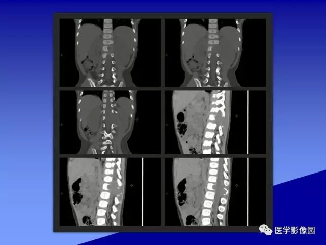 【病例】腰椎嗜酸性肉芽肿1例X线CT及MR影像表现
