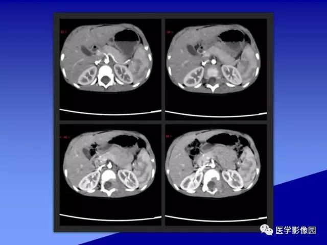 【病例】腰椎嗜酸性肉芽肿1例X线CT及MR影像表现
