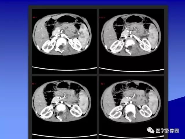 【病例】腰椎嗜酸性肉芽肿1例X线CT及MR影像表现
